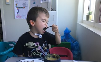 A small child with a feeding tube on his neck feeds himself with a fork